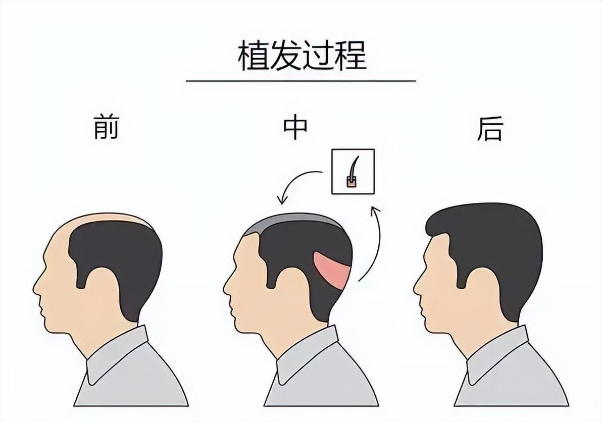 最新脱发研究及治疗方法