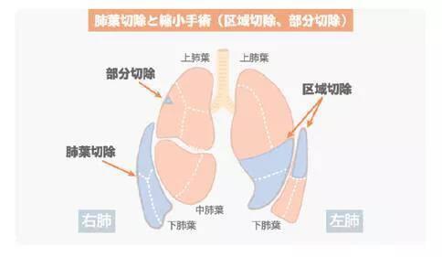 肺大泡最新治疗方案，探索与进展